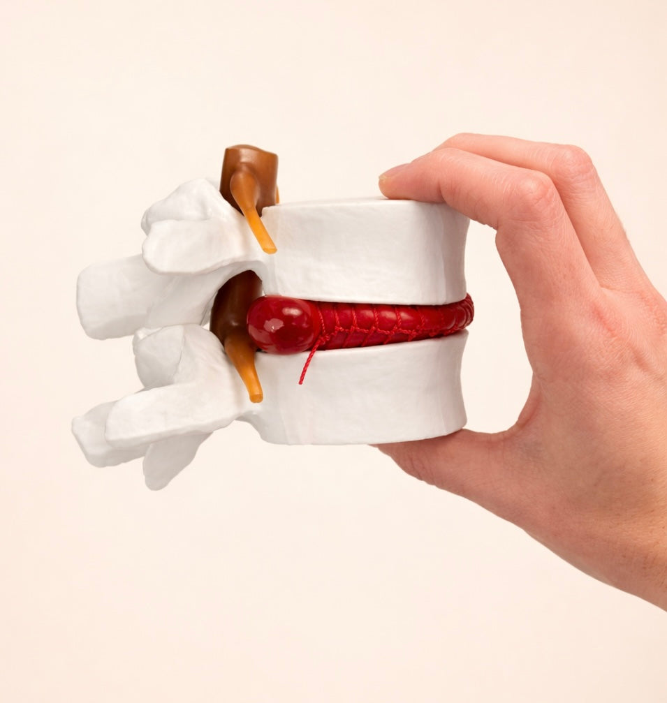 Bandscheibenvorfall-Modell