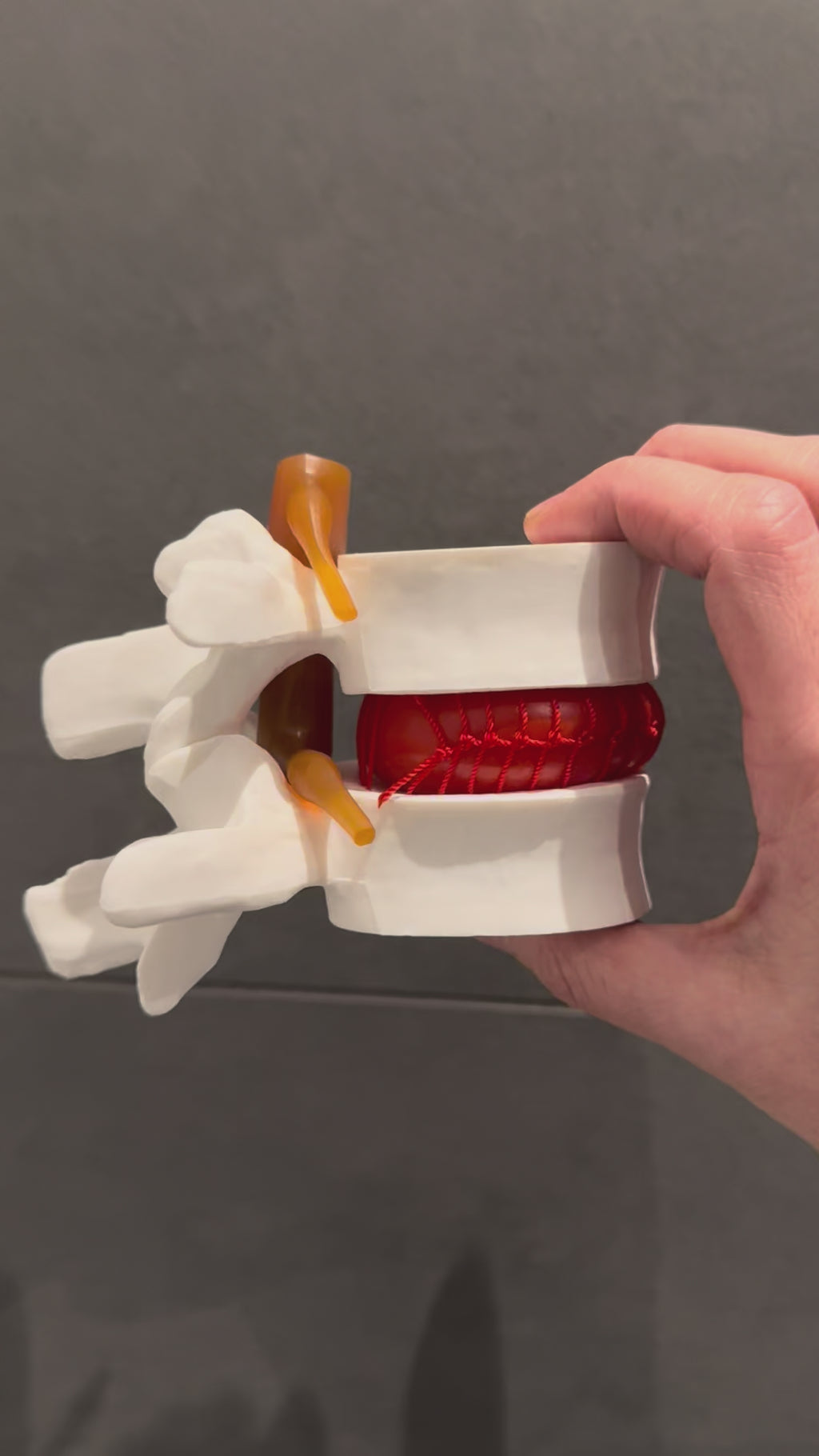 Bandscheibenvorfall-Modell